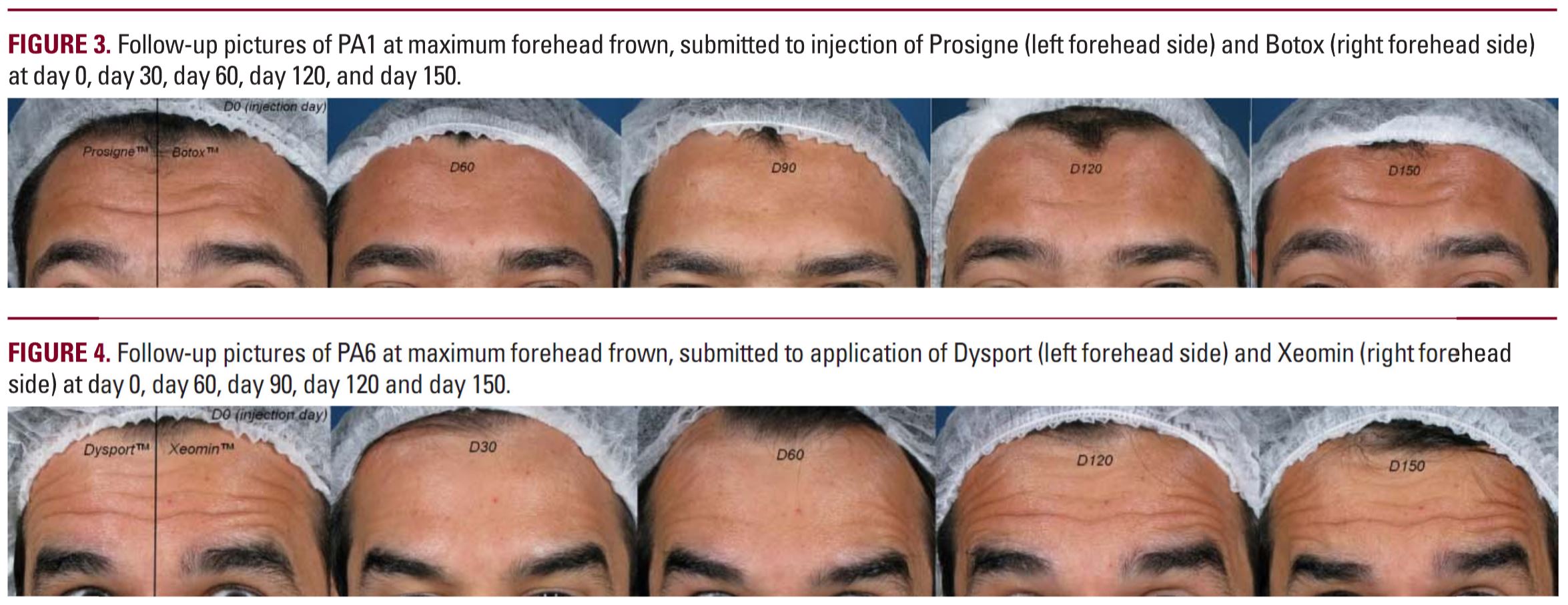 Figuras clínicas do estudo — comparação de quatro toxinas botulínicas tipo A em linhas de testa em homens · Morais OO et al. · JDD 2012