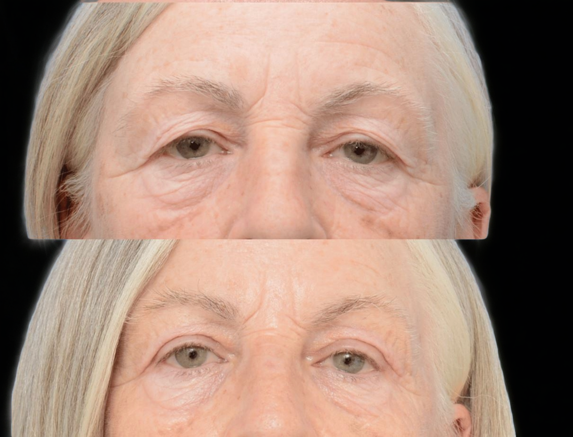 Blefaroplastia superior — resultado pré e pós