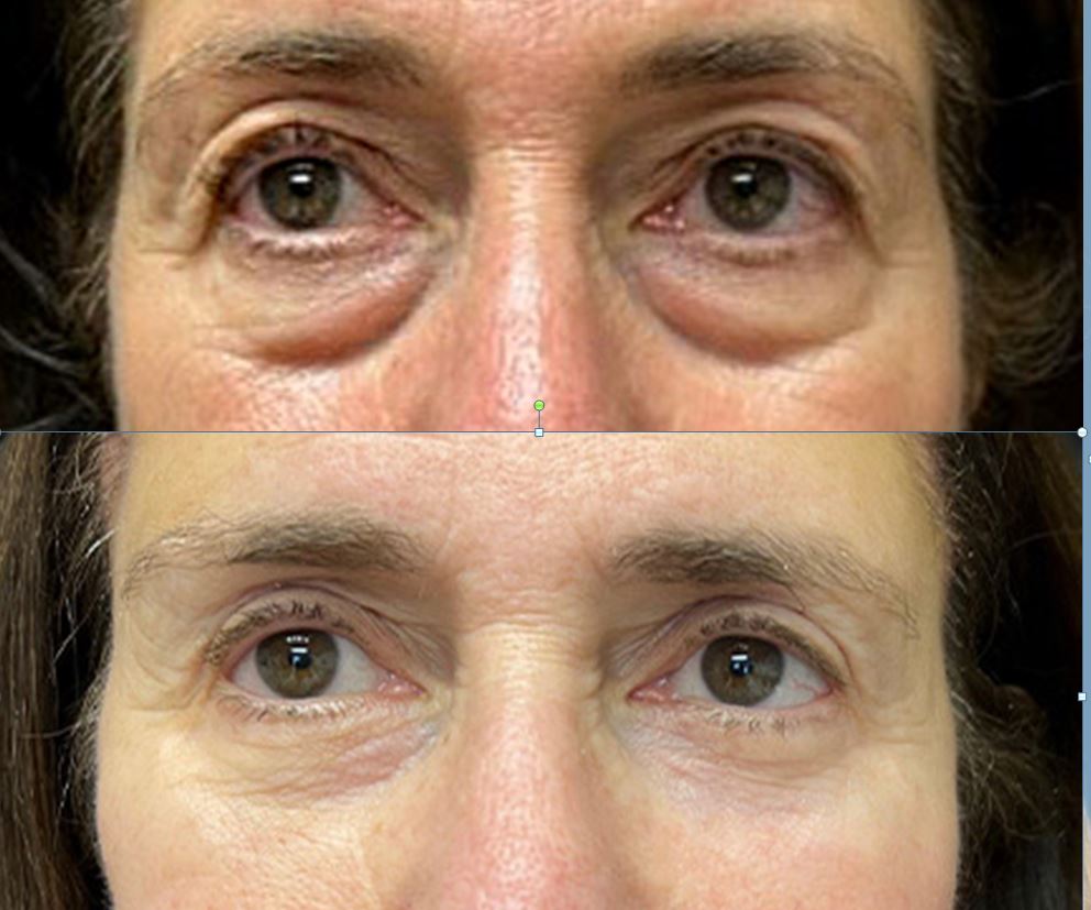 Blefaroplastia inferior — resultado pré e pós