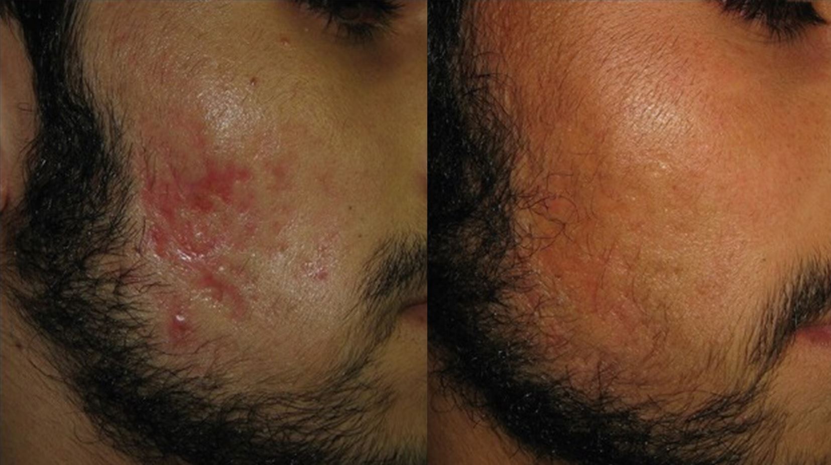 Antes e depois de tratamento de cicatrizes de acne com laser CO₂ fracionado ablativo — Clínica Avallon Brasília, Dr. Orlando Morais