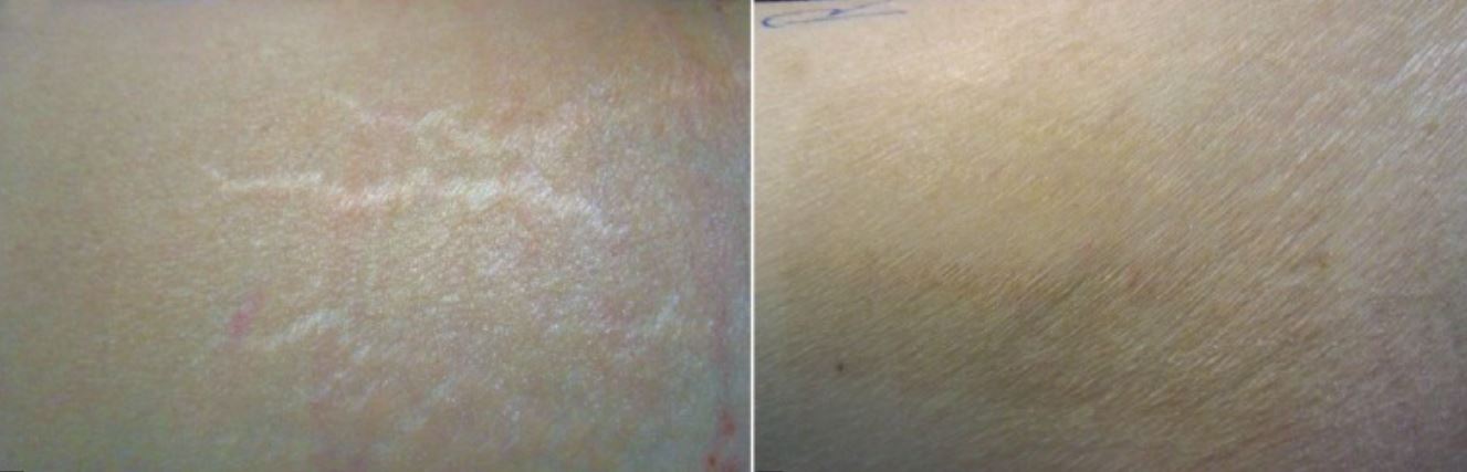 Antes e depois de tratamento de estrias com laser CO₂ fracionado — Clínica Avallon Brasília, Dr. Orlando Morais