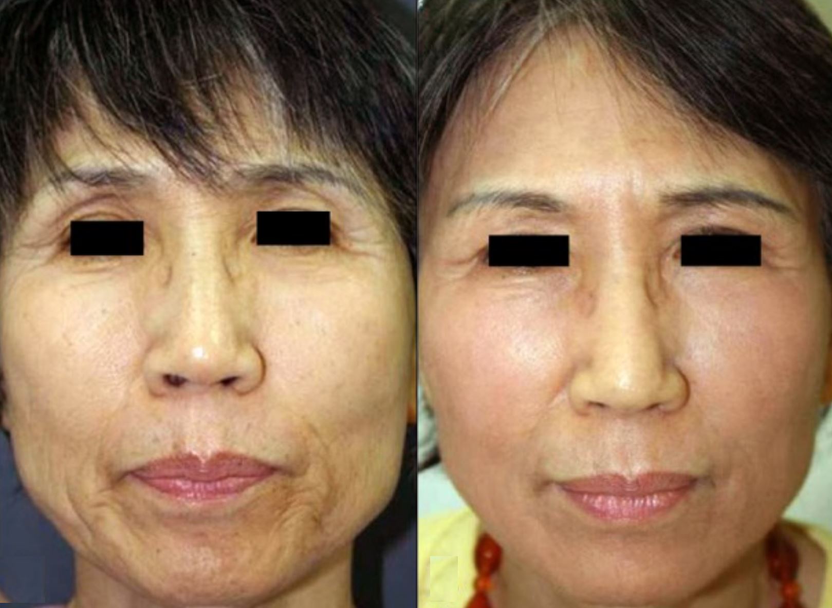Antes e depois de tratamento de fotodano e rugas com laser CO₂ fracionado — Clínica Avallon Brasília, Dr. Orlando Morais