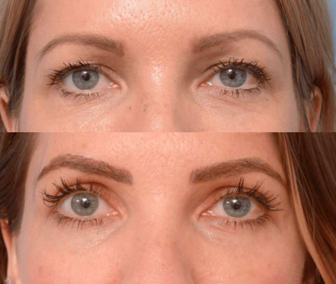 Lifting de supercílios — técnica de Castanhares