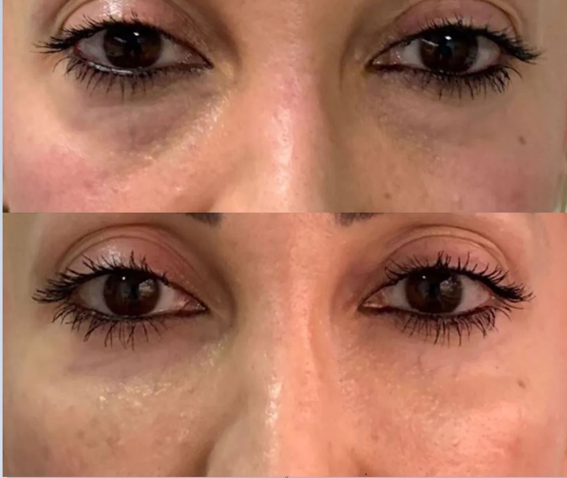 Lipoenxertia e células-tronco — Fat4Beauty