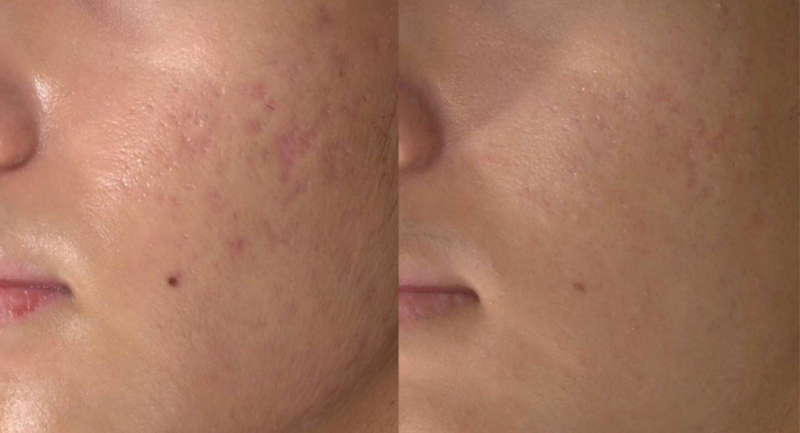 Ilustração do drug delivery: microcanais do laser CO₂ permitindo entrega do PLLA na derme