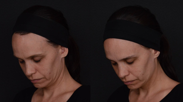 Paciente tratada com Sculptra — rejuvenescimento facial antes e depois · Clínica Avallon Brasília