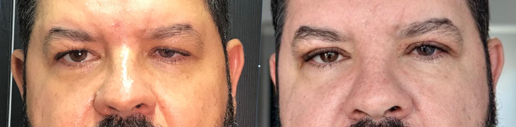 Blefaroplastia superior e correção de ptose unilateral · paciente da Clínica Avallon · antes e depois · Dra. Dayane Shinzato — Brasília-DF