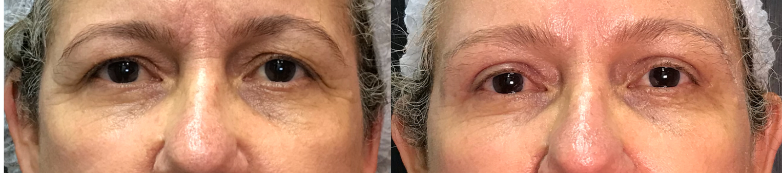 Blefaroplastia superior com remoção de pele e gordura medial · antes e depois · Clínica Avallon Brasília