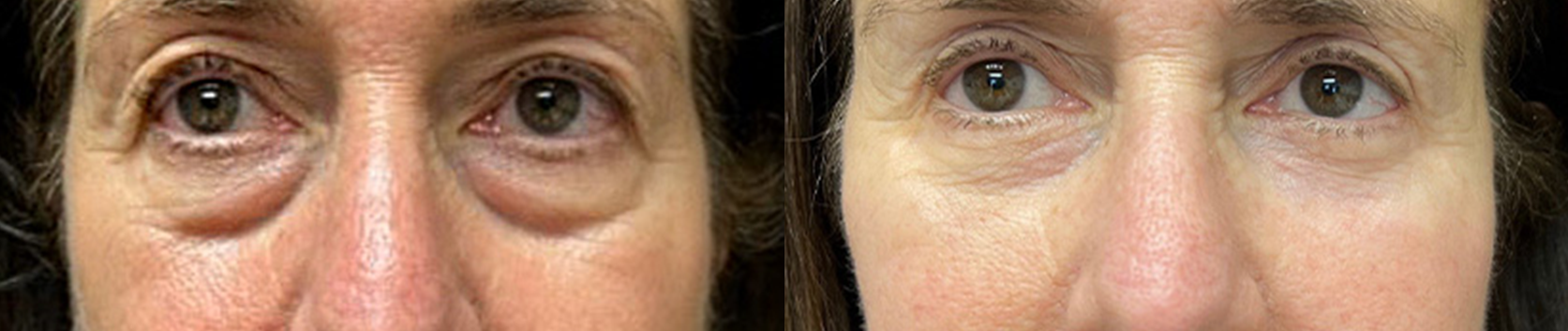 Blefaroplastia inferior transcutânea com cantopexia · antes e depois · Clínica Avallon Brasília