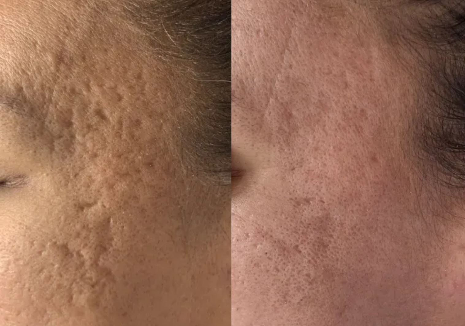 Tratamento de cicatrizes de acne com Dermapen — antes e depois com redução das cicatrizes atróficas, Clínica Avallon, Brasília