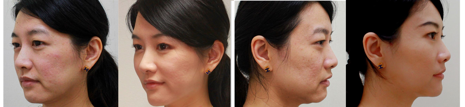 Paciente tratada com Ellansé — resultado de rejuvenescimento facial antes e depois, Clínica Avallon Brasília