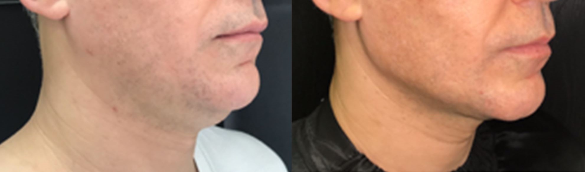 Endolaser + aspiração de papada: Recuperação do contorno cervicofacial · Clínica Avallon Brasília