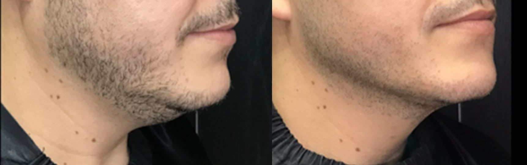 Endolaser papada — antes e depois · Clínica Avallon Brasília