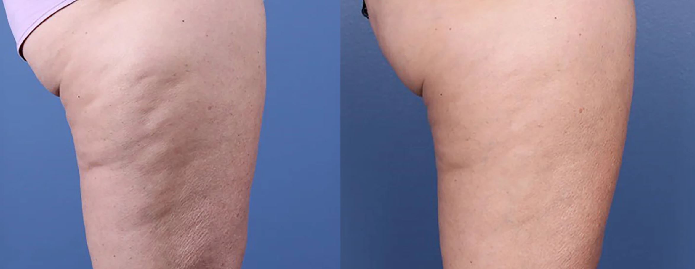 Antes e depois de tratamento com Morpheus8 (radiofrequência microagulhada) para melhora de celulite e flacidez em coxas, Clínica Avallon Brasília
