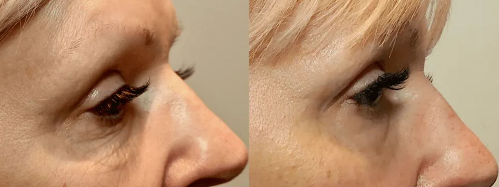Antes e depois de tratamento com Morpheus8 (radiofrequência microagulhada) para melhora de rugas finas e flacidez de pálpebras inferiores em paciente feminina, Clínica Avallon Brasília