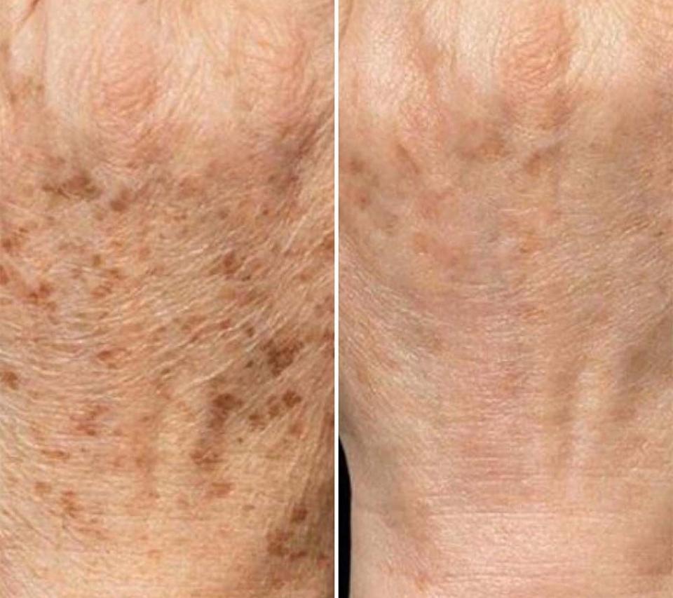 Antes e depois de melanoses no dorso das mãos com Laser QuadriPico picossegundos — Clínica Avallon Brasília