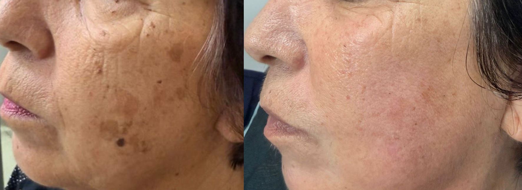 Antes e depois de tratamento de melanoses e queratoses seborreicas com Laser QuadriPico picossegundos — Clínica Avallon Brasília
