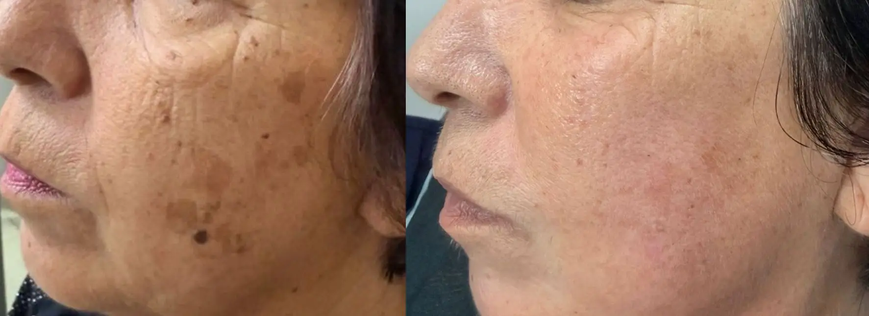 Antes e depois de tratamento de melanoses e queratoses seborreicas com Laser QuadriPico picossegundos — Clínica Avallon Brasília