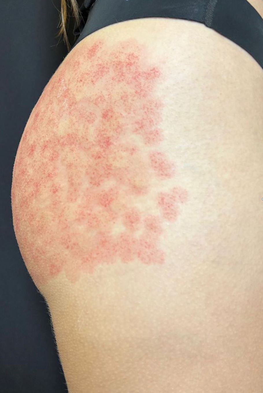 Aspecto imediato após sessão de Laser QuadriPico em estrias — pele com eritema e clareamento esbranquiçado característicos do efeito fotoacústico, Clínica Avallon Brasília