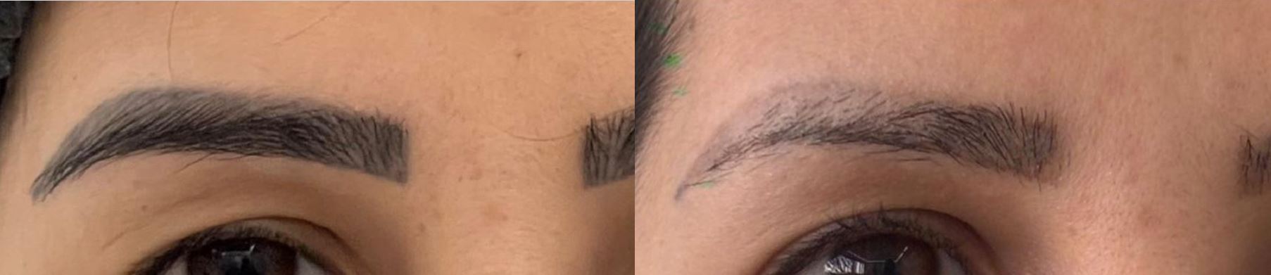 Antes e depois de remoção de tatuagem em sobrancelhas (micropigmentação) com Laser QuadriPico picossegundos — Clínica Avallon Brasília