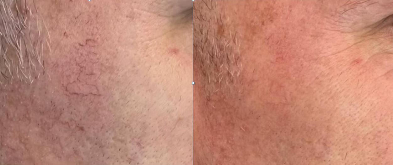 Antes e depois de tratamento de telangiectasias e vasos finos com Laser QuadriPico picossegundos — Clínica Avallon Brasília
