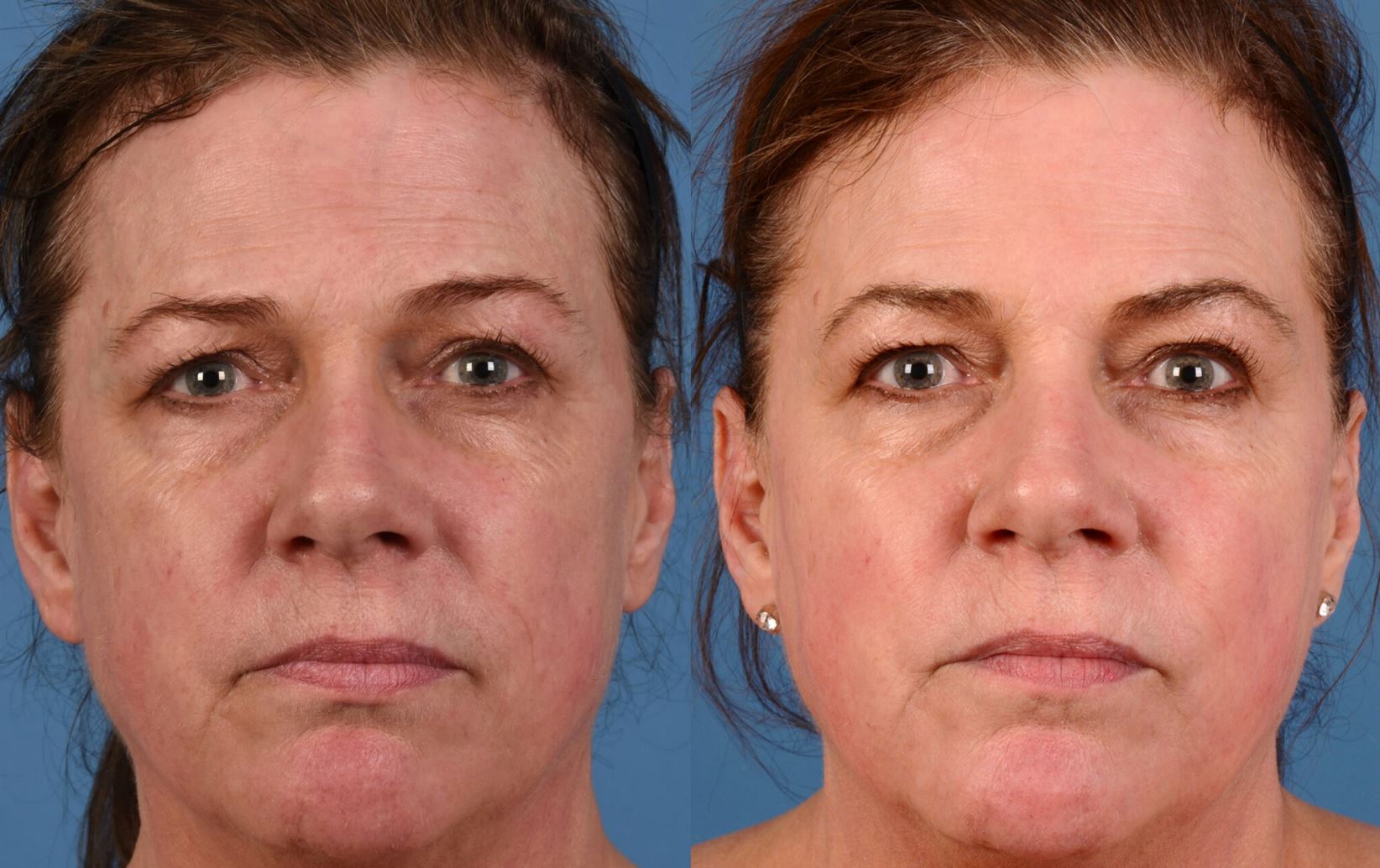 Rejuvenescimento facial com Dermapen — antes e depois com melhora de luminosidade, rugas finas e poros abertos, Clínica Avallon, Brasília