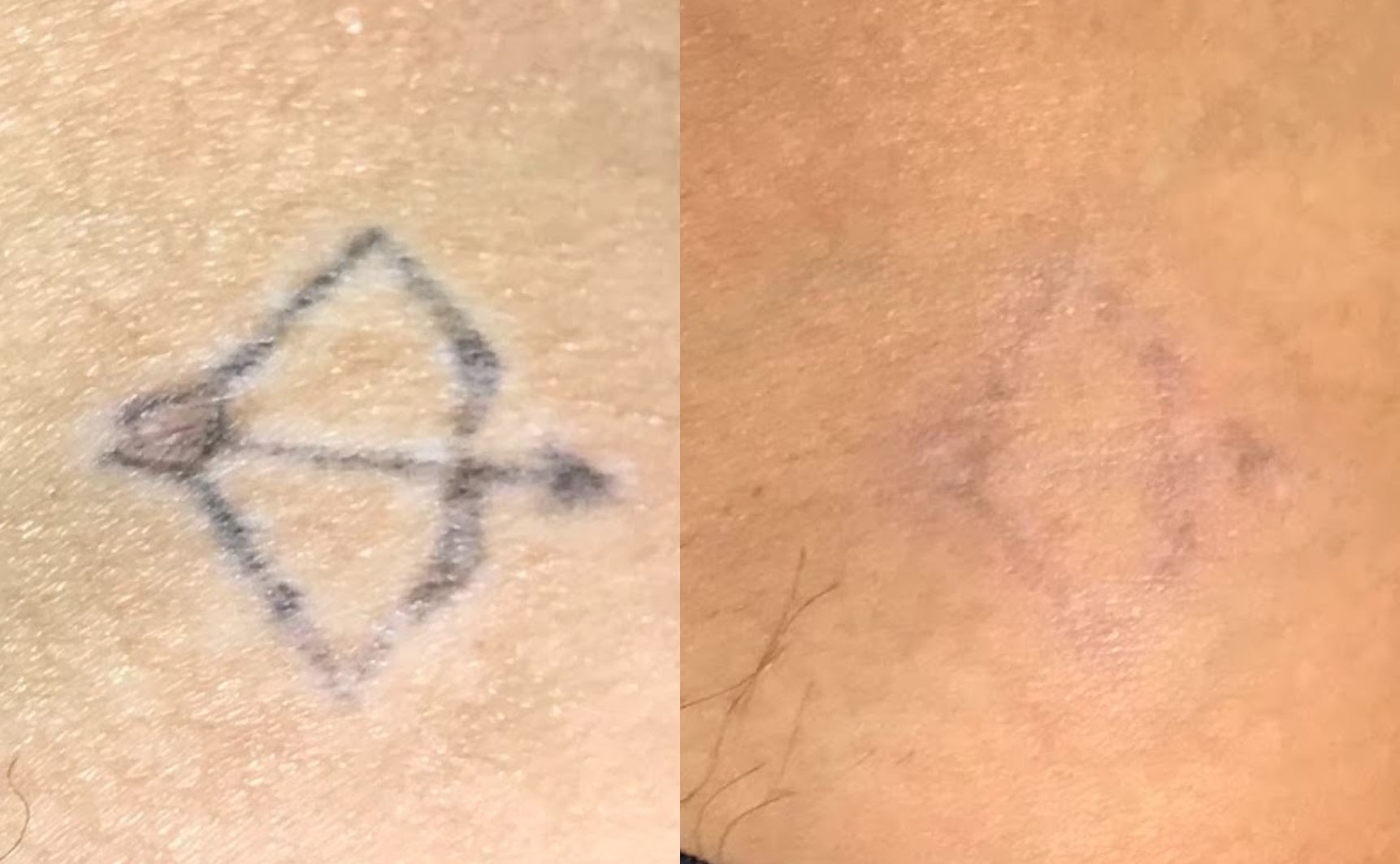 Antes e depois de remoção de tatuagem corporal com Laser QuadriPico picossegundos — Clínica Avallon Brasília
