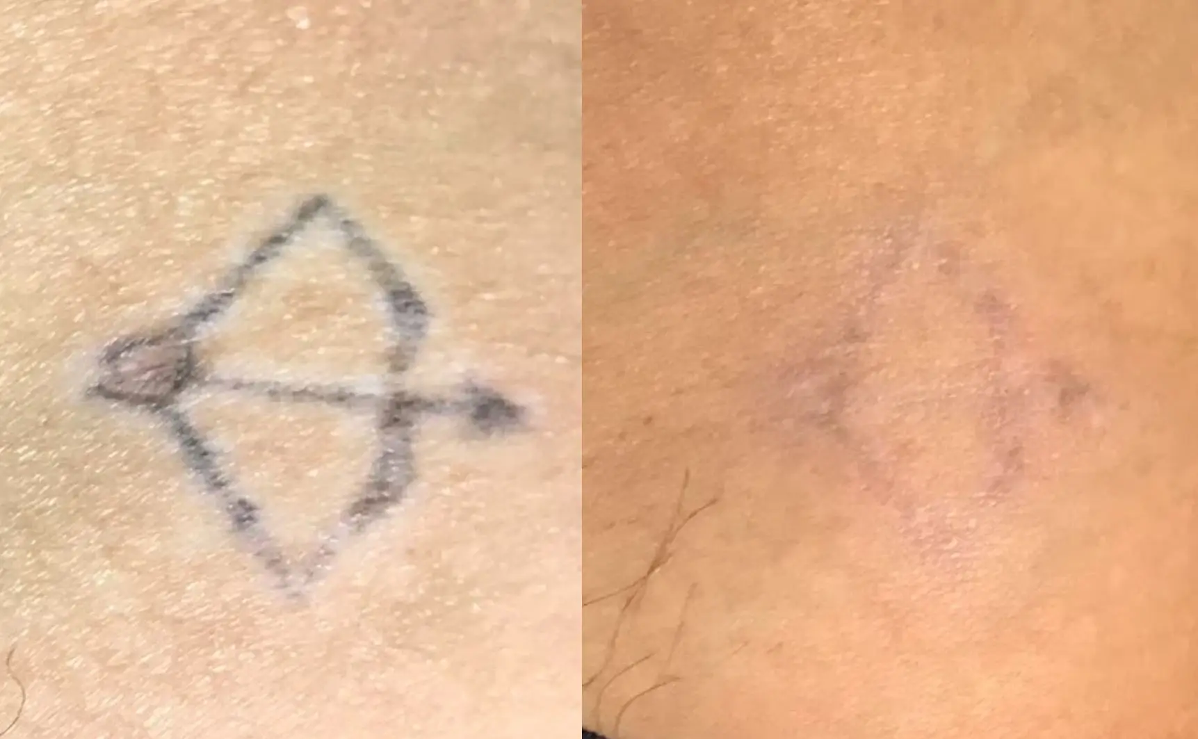 Antes e depois de remoção de tatuagem corporal com Laser QuadriPico picossegundos — Clínica Avallon Brasília