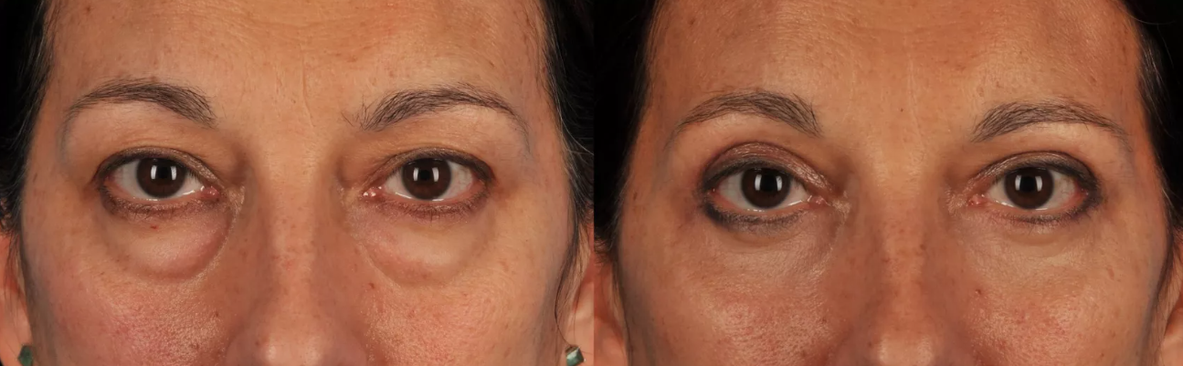 Blefaroplastia inferior transconjuntival e superior · antes e depois