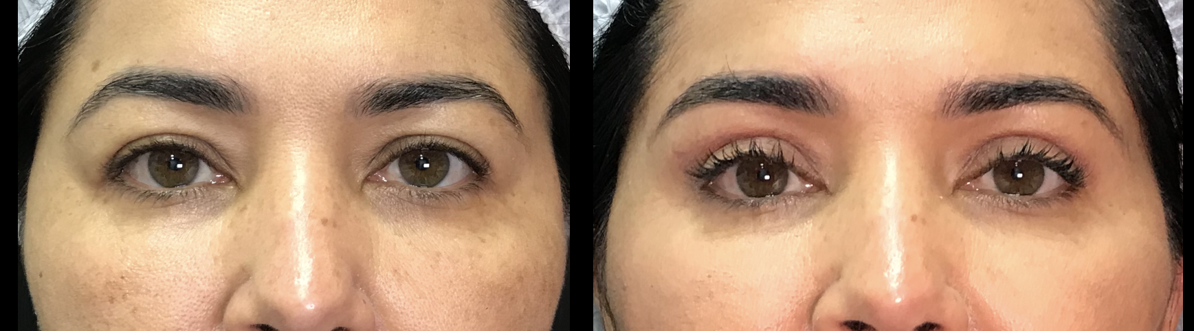 Resultado blefaroplastia superior com remoção de pele e gordura medial