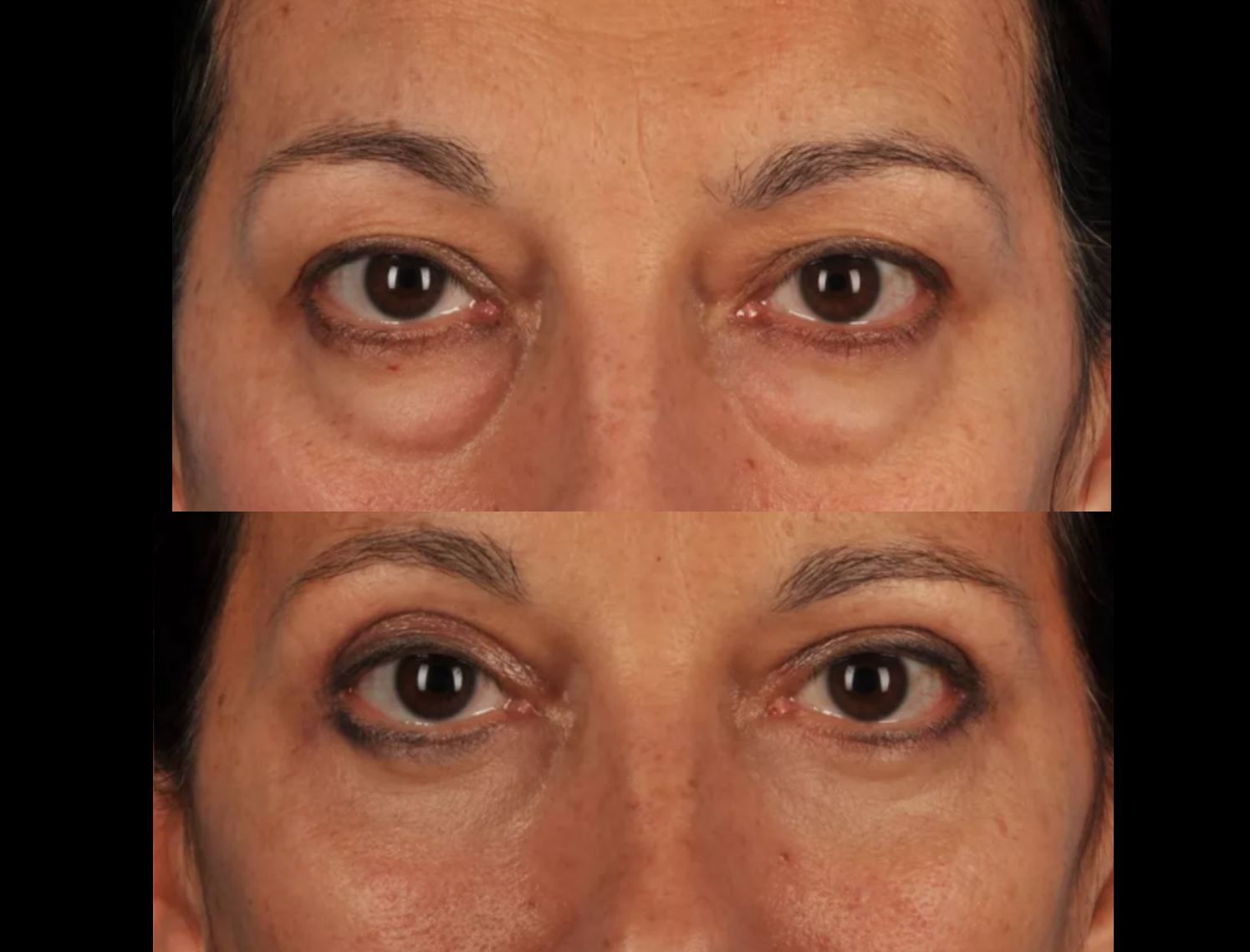 Blefaroplastia inferior — antes e depois, Clínica Avallon Brasília